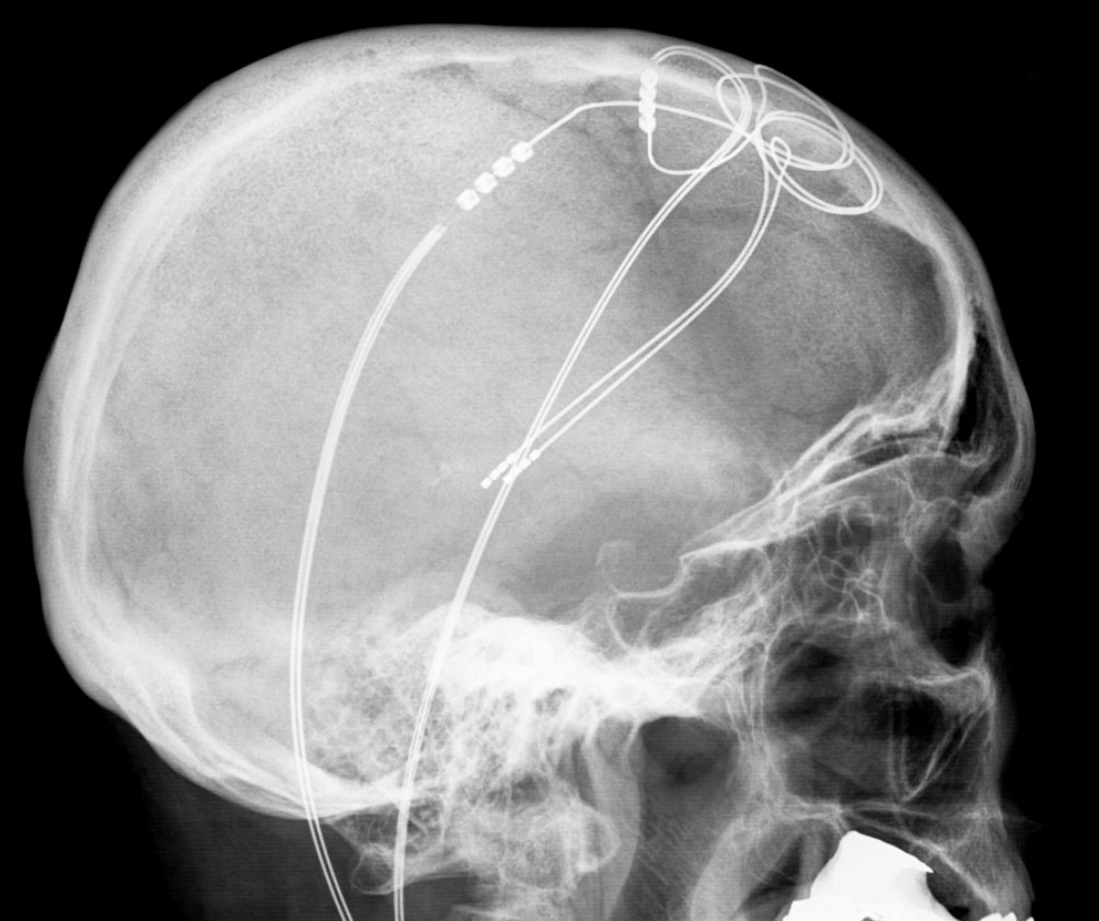 Probes that can transmit electricity inside the skull raise questions about personal autonomy and responsibility. - Image Credit: Hellerhoff via Wikimedia Commons - CC BY-SA