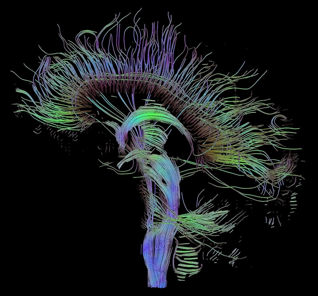 Neural pathways in the brain. - Image Credit: Thomas Schultz via Wikimedia Commons
