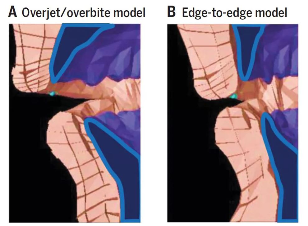 Biomechanical model of producing an ‘f’ sound with an overbite/overjet (left) versus an edge-to-edge bite (right). - Image Credit: Scott Moisik, CC BY-ND
