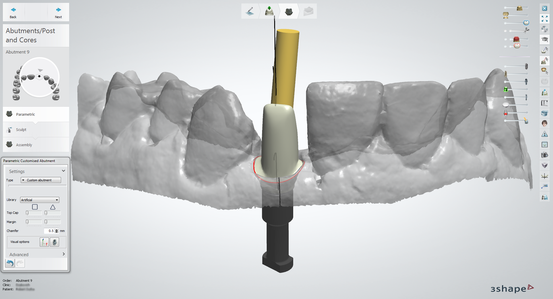 Angulated screw channel (facial)