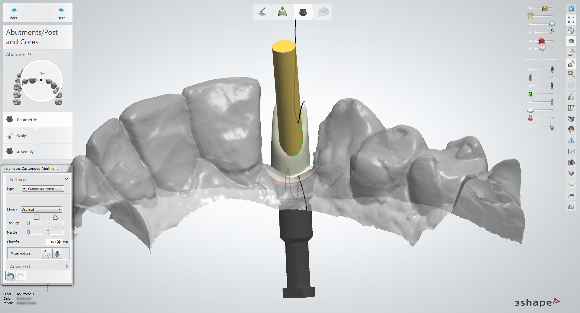 Angulated screw channel (lingual)