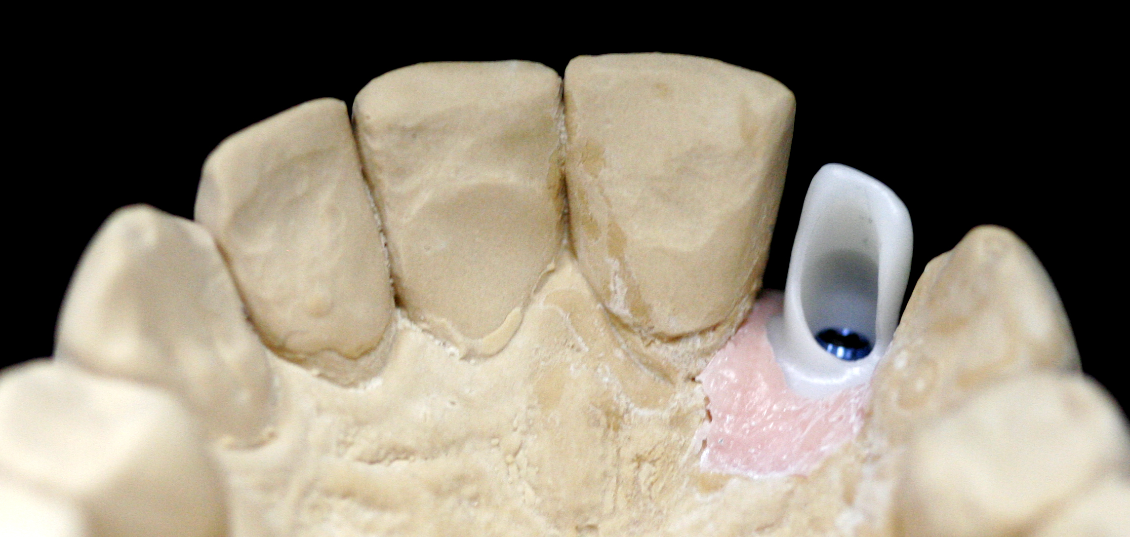 Milled ASC zirconia abutment on model