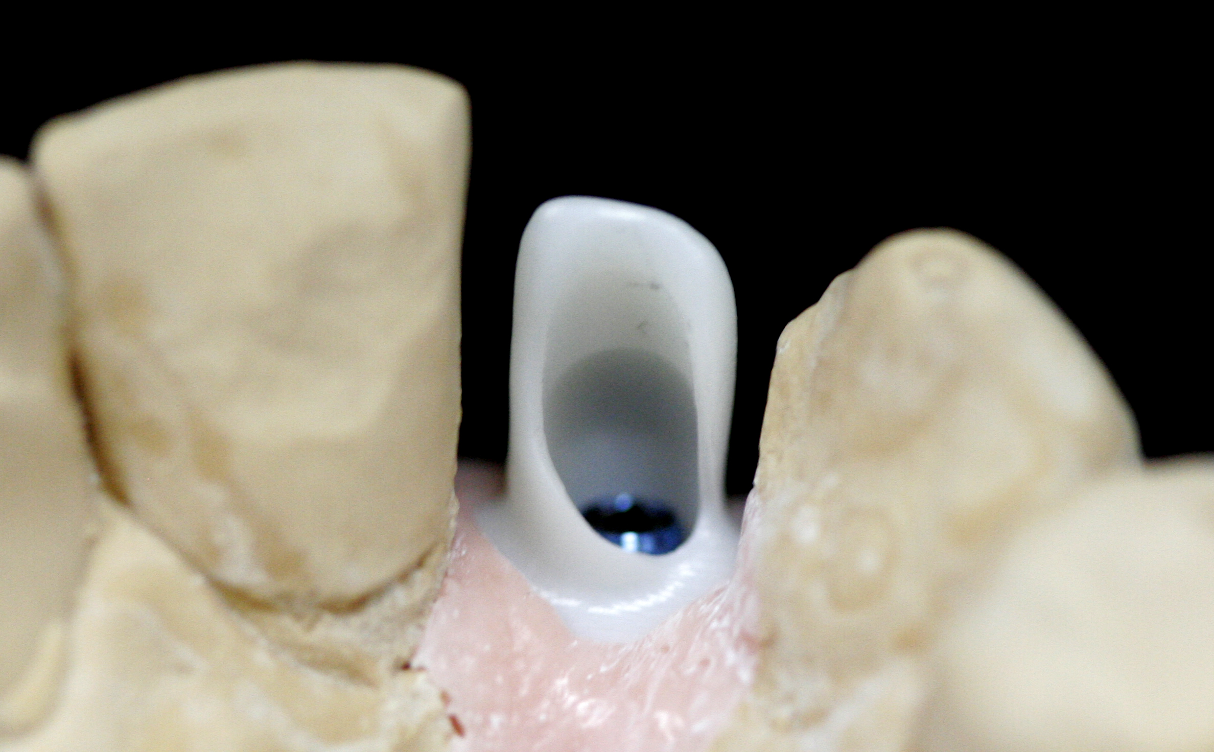 Milled ASC zirconia abutment on model