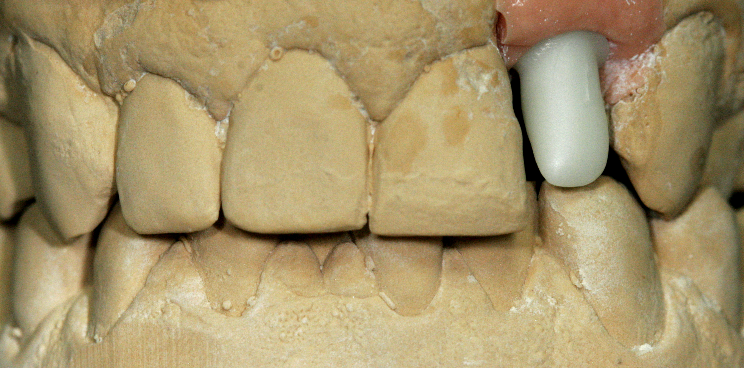 Milled ASC zirconia abutment on model