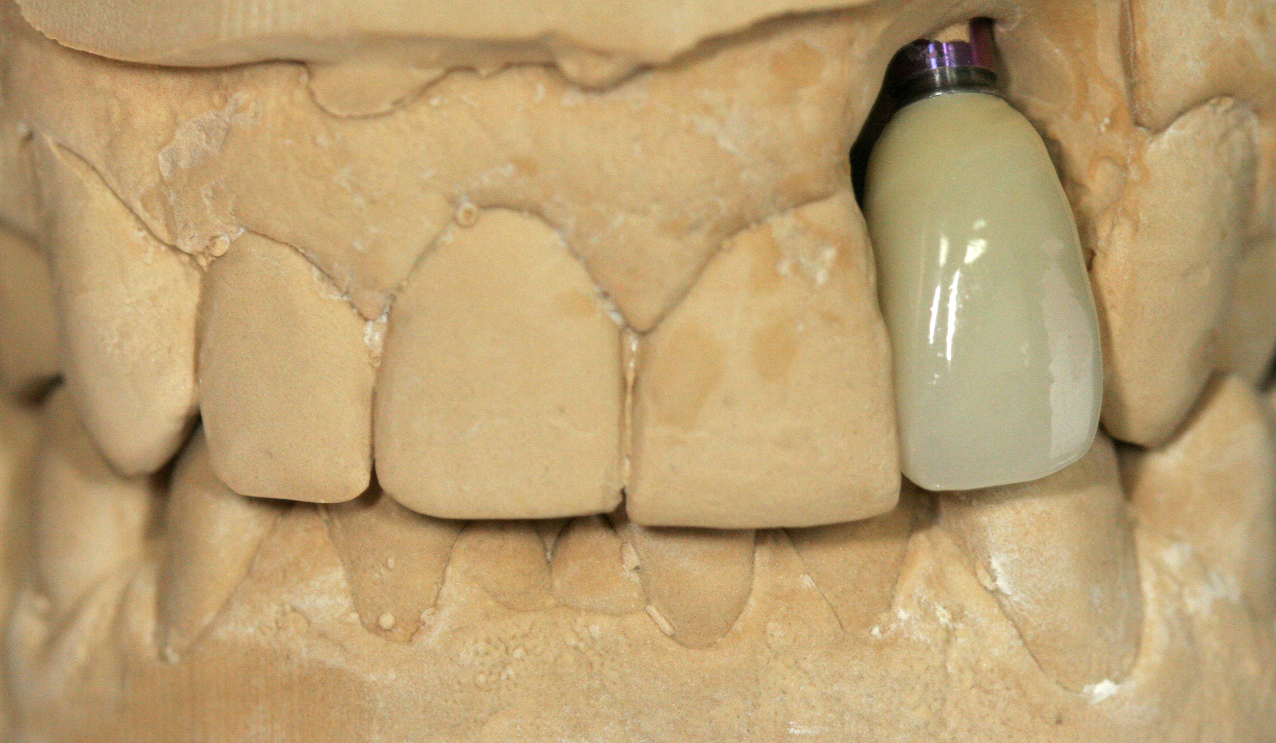 Finished SMT Layered Zirconia implant crown on model