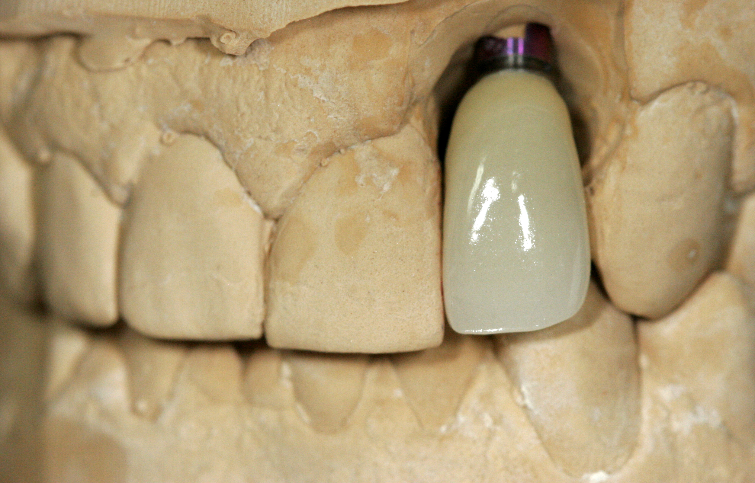 Finished SMT Layered Zirconia implant crown on model