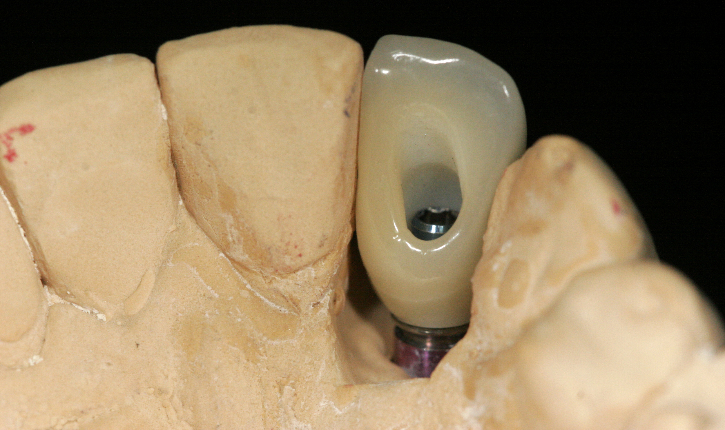 Finished SMT Layered Zirconia implant crown on model