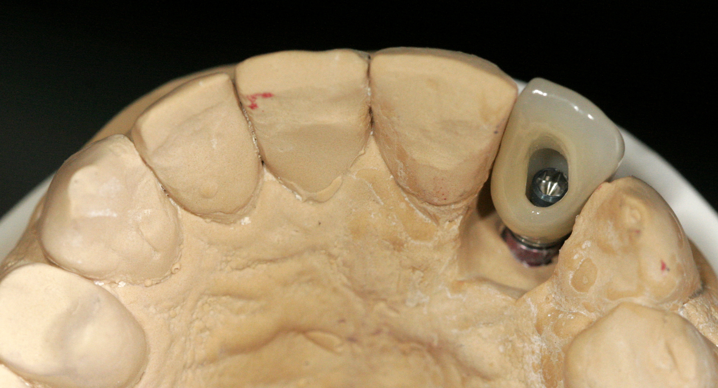 Finished SMT Layered Zirconia implant crown on model