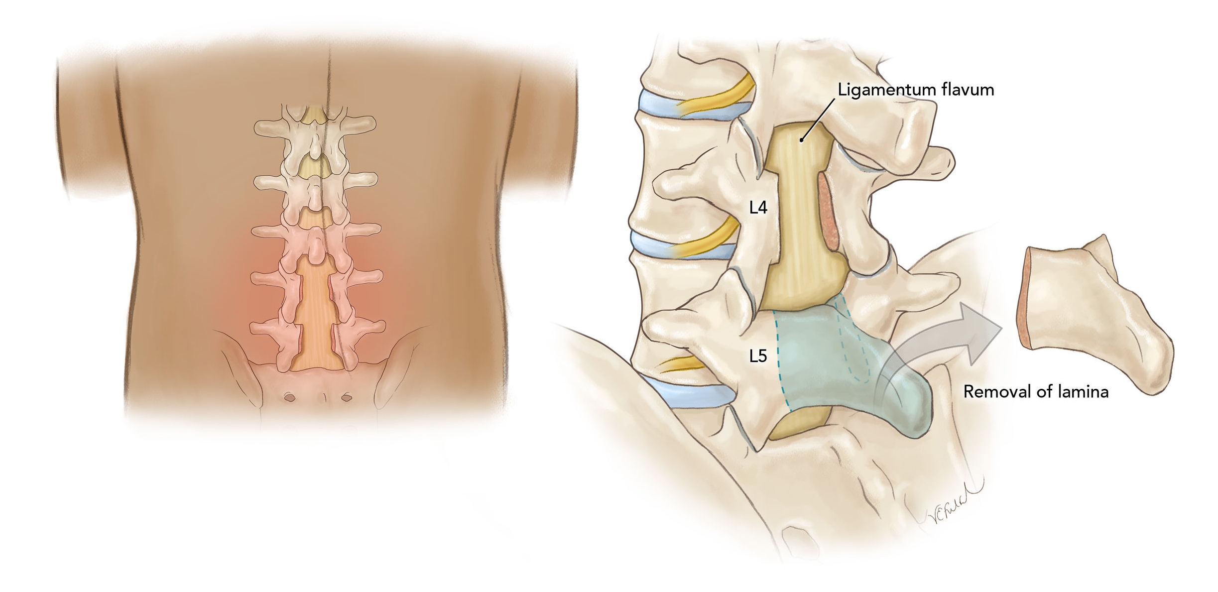 Laminectomy_1.jpg