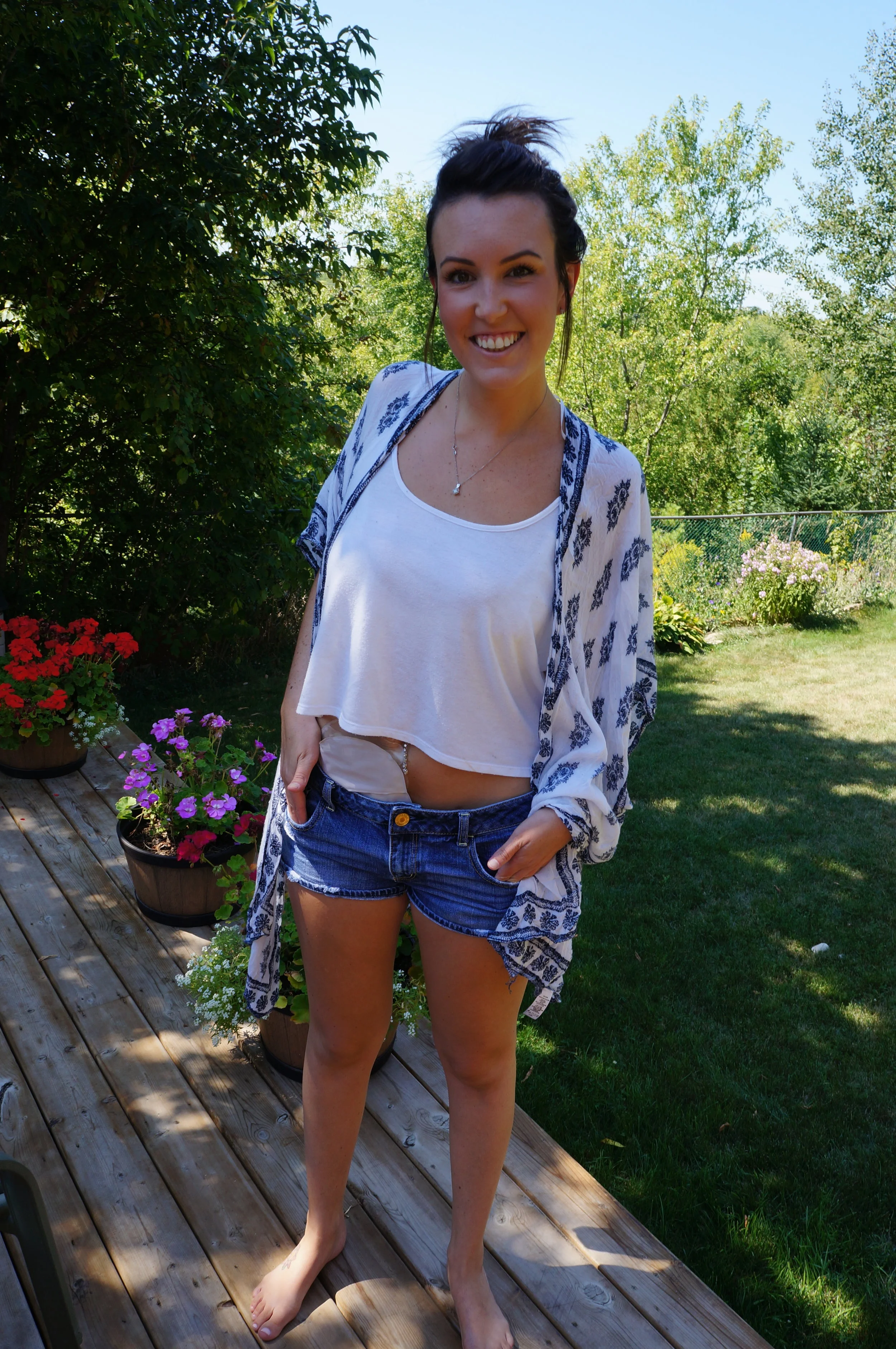 Ma colite ulcéreuse