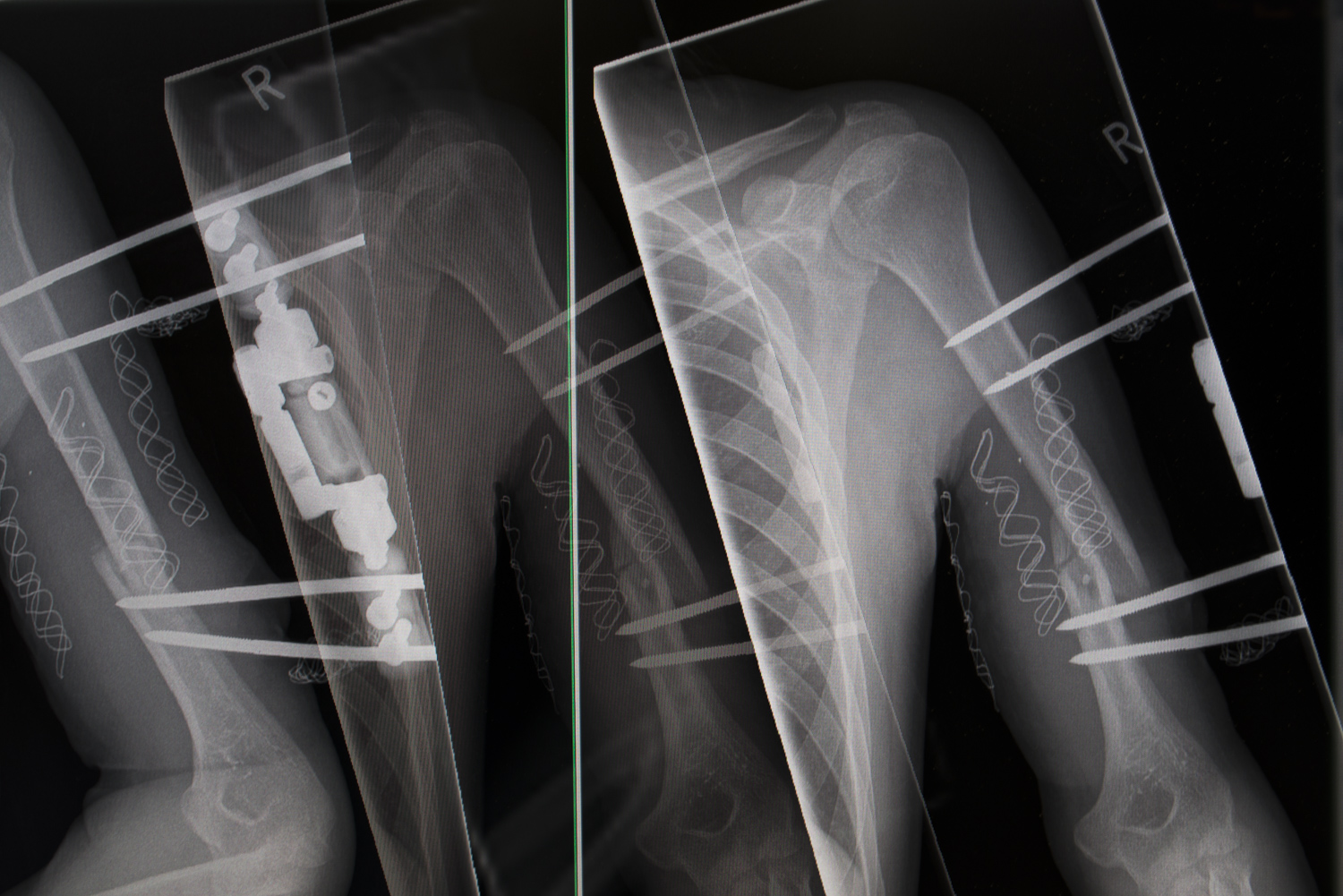  X-ray shows the injury he received in Syria as the bomb fell on his home town in Jasim. He has broken arm that received surgeries in Germany and also a puncture wound on his stomache.&nbsp;  The arm causes him pain, limits his movement, and can't li