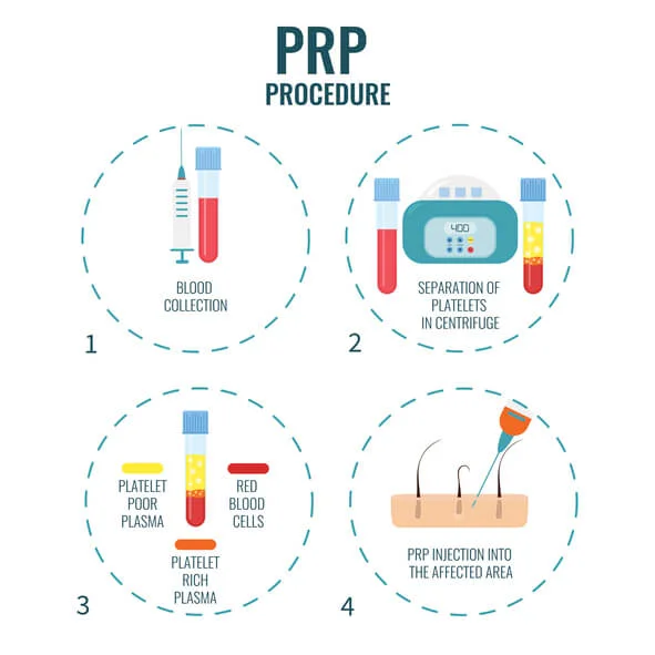 What is PRP Treatment.jpg