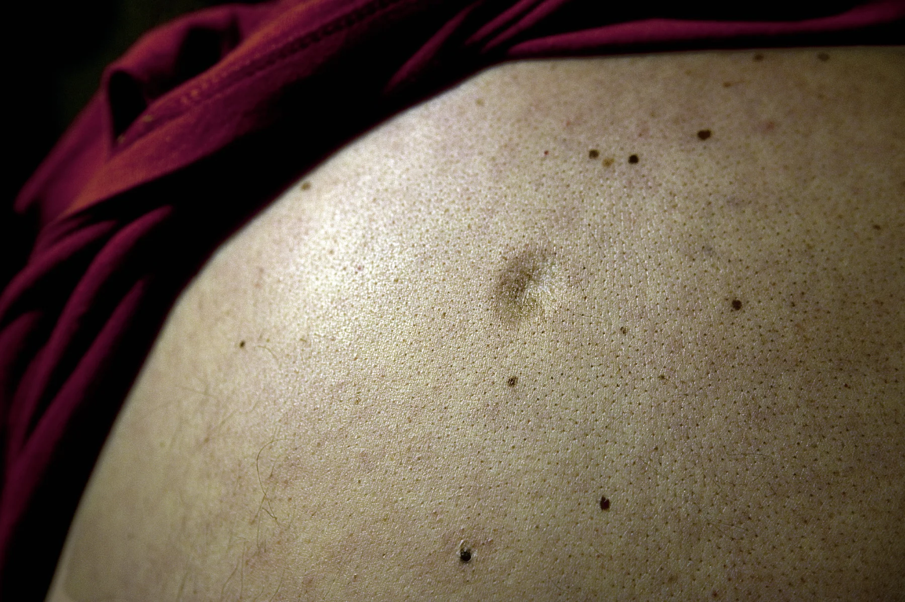  Merrimac WV (USA), September 2010 - Back of coal field resident who contracted a melanoma from water drinking in Rawl, Mingo county. All his family have been affected by water pollution. Rawl is in one the poorest area of Mingo Co. Well water pollut