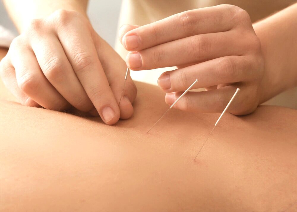 L'acupuncture en médecine intégrative