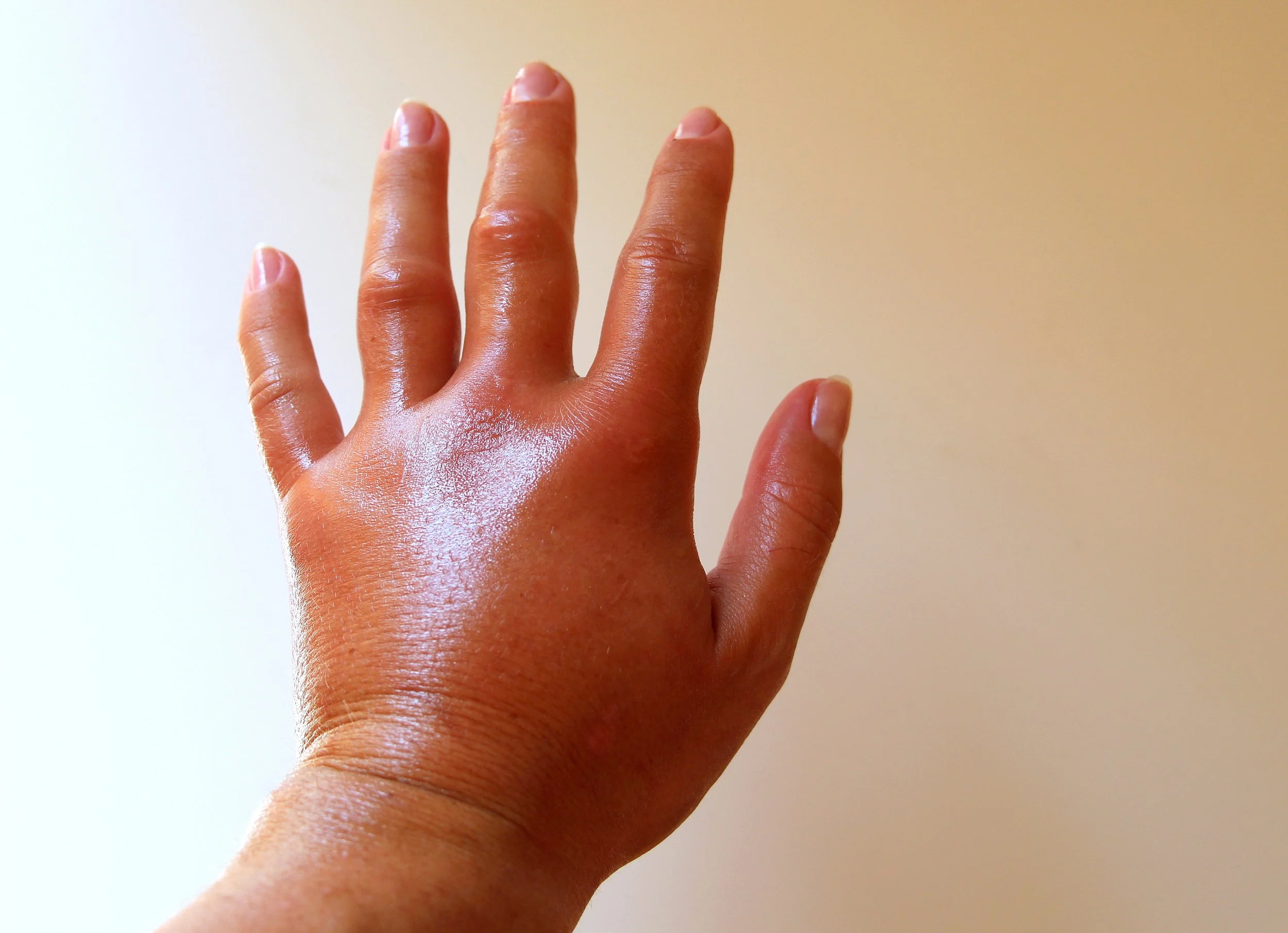 Atelier estime de soi : Qu’est-ce que Syndrome mains pieds