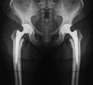 Arthroplasty, the reconstruction or replacement of a joint, as shown here in this hip x-ray, is big business for aging baby boomers.