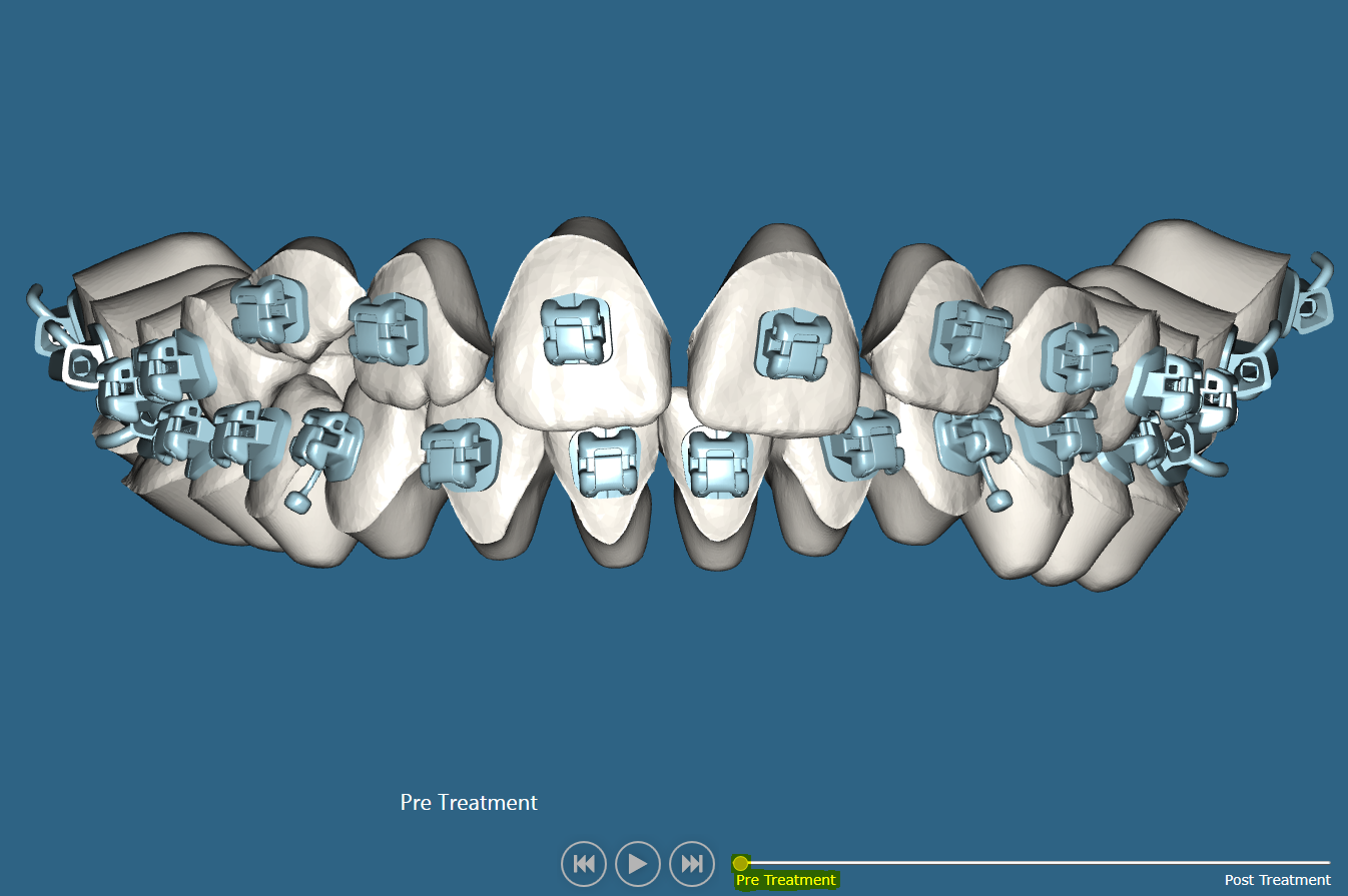 Note: Use slider bar to bring setup back and forth between treatment modes.