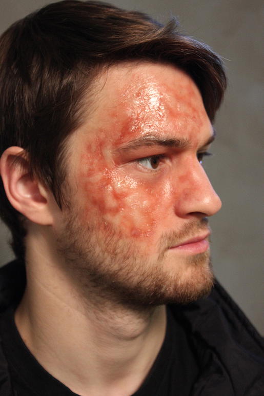 Prosaide Transfer Burn