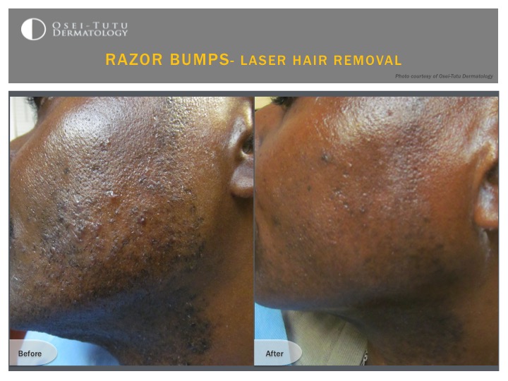 Laser Hair Removal Osei Tutu Dermatology