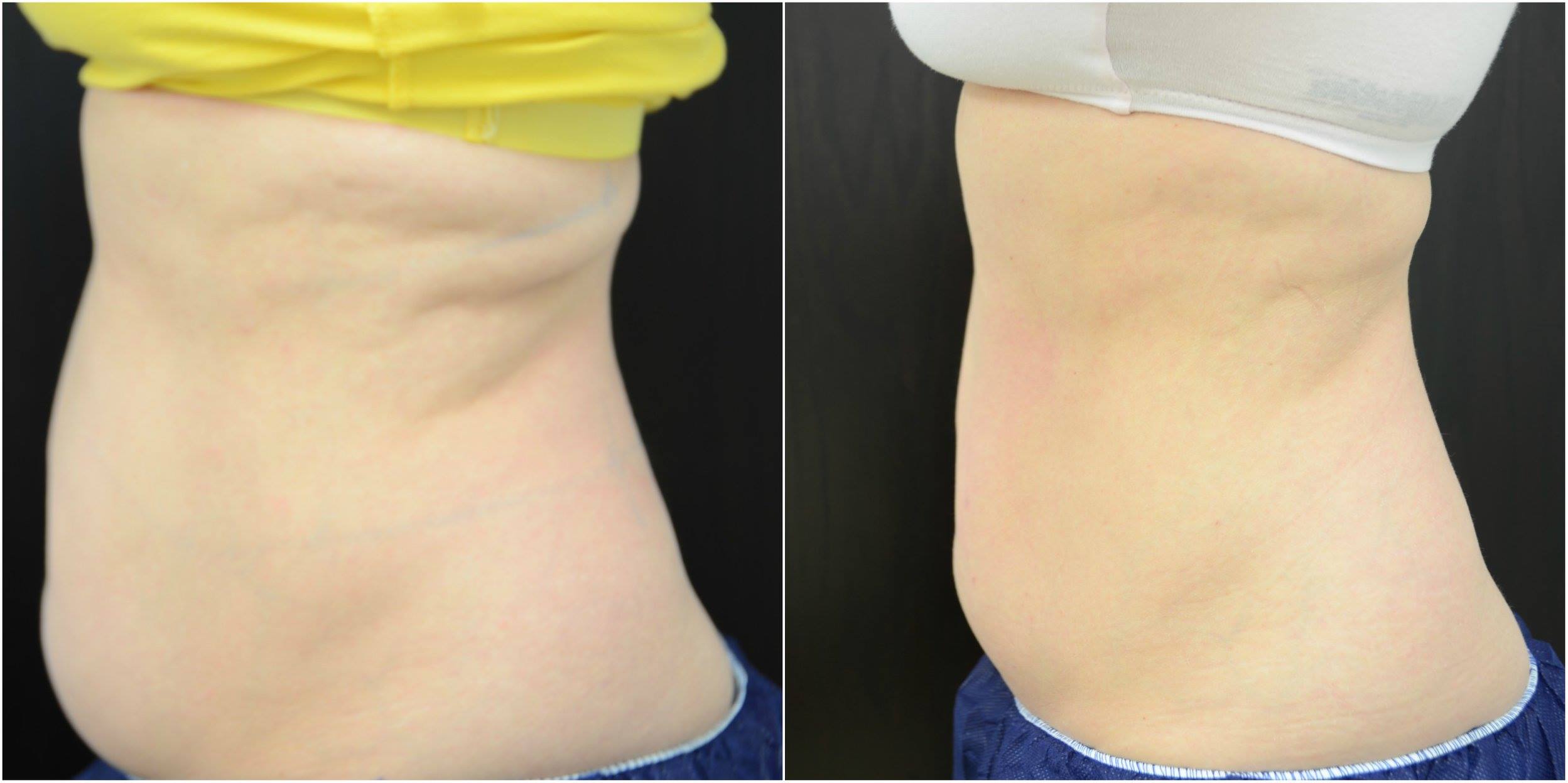 THESE RESULTS ARE 4 WEEKS AFTER THE FIRST TREATMENT. PATIENT IS OF MAYA MEDI-SPA/ DR CHANDRA YESHLUR