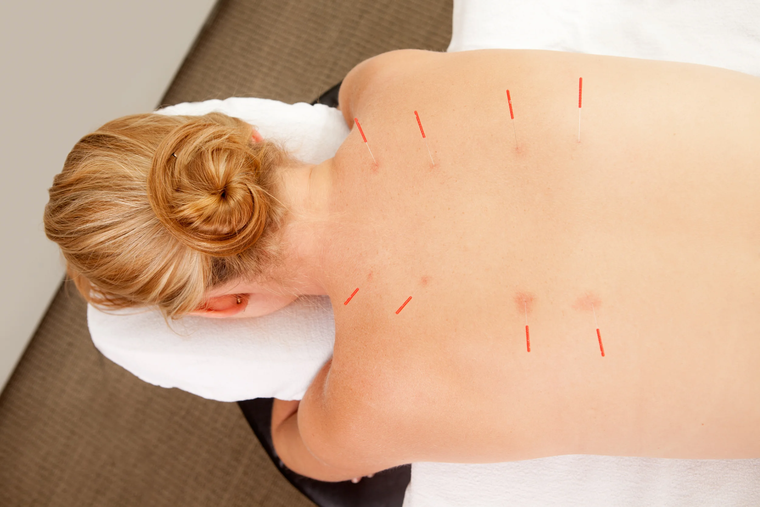 acupuncture in skin 3 large.jpg