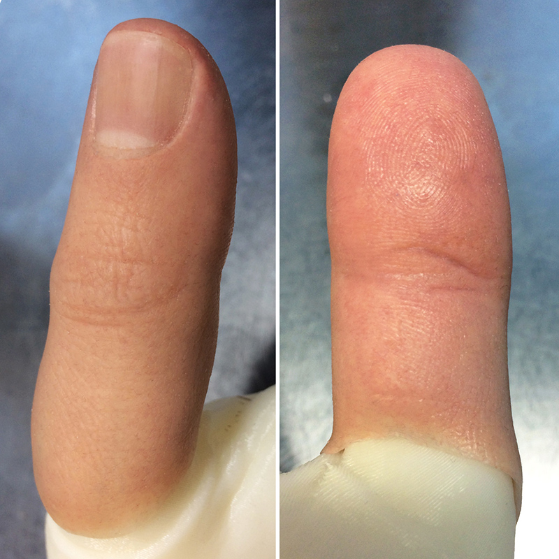 Pressure-fit thumb prosthesis