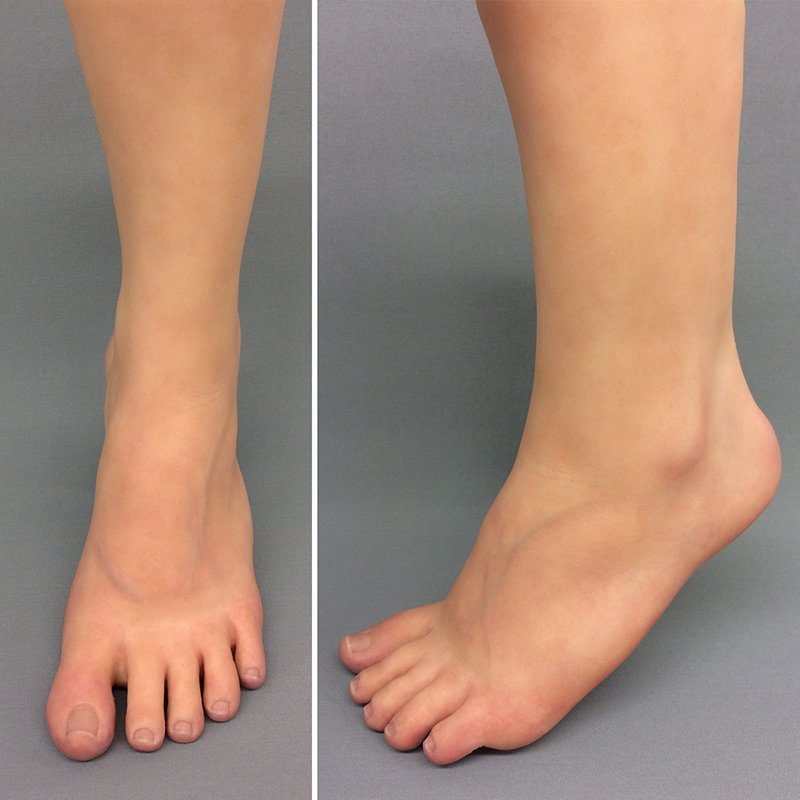 Custom silicone partial foot prosthesis and toe prosthesis