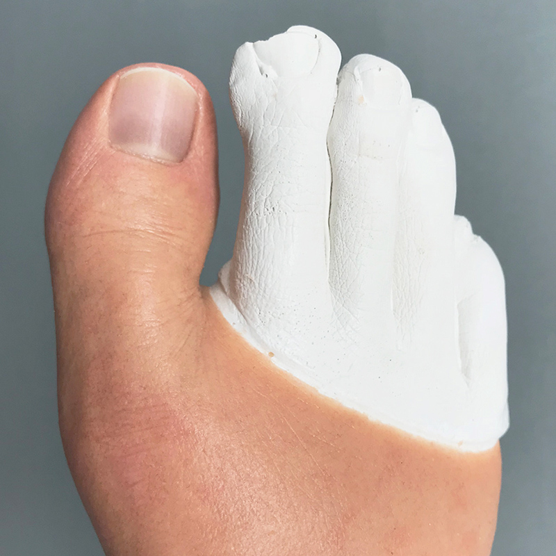 Toe prosthesis with retentive band