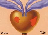 Pinchot_ClinicalStageFig4.jpg