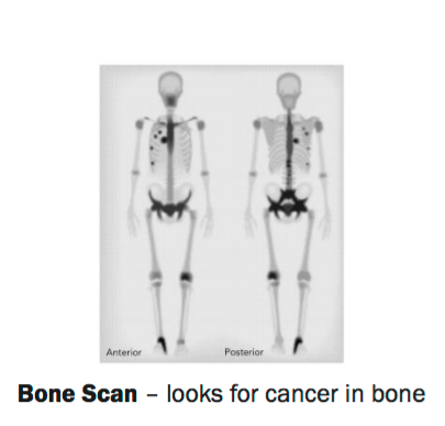 FIGURE 1 Bone Scan – looks for cancer in bone