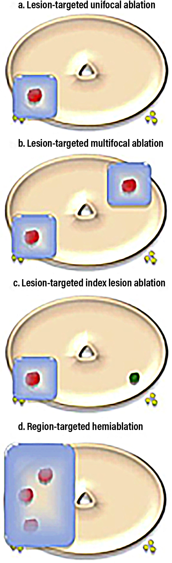 recovery after prostate hifu)