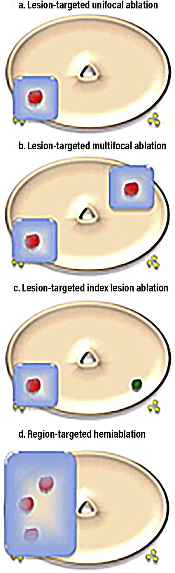 Courtesy of: V. Kasivisvanathan, M. Emberton, H.U. Ahmed. Focal Therapy for Prostate Cancer: Rationale and Treatment Opportunities. Clinical Oncology 25 (2013) 461e473