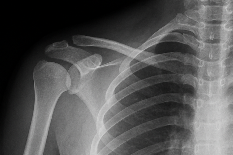 Healing Bones with Technology: Electroacupuncture for Bone Injuries
