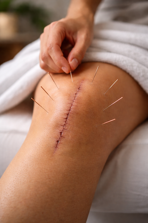 Acupuncture for Post-Surgical Recovery:&nbsp;Supporting Healing Naturally