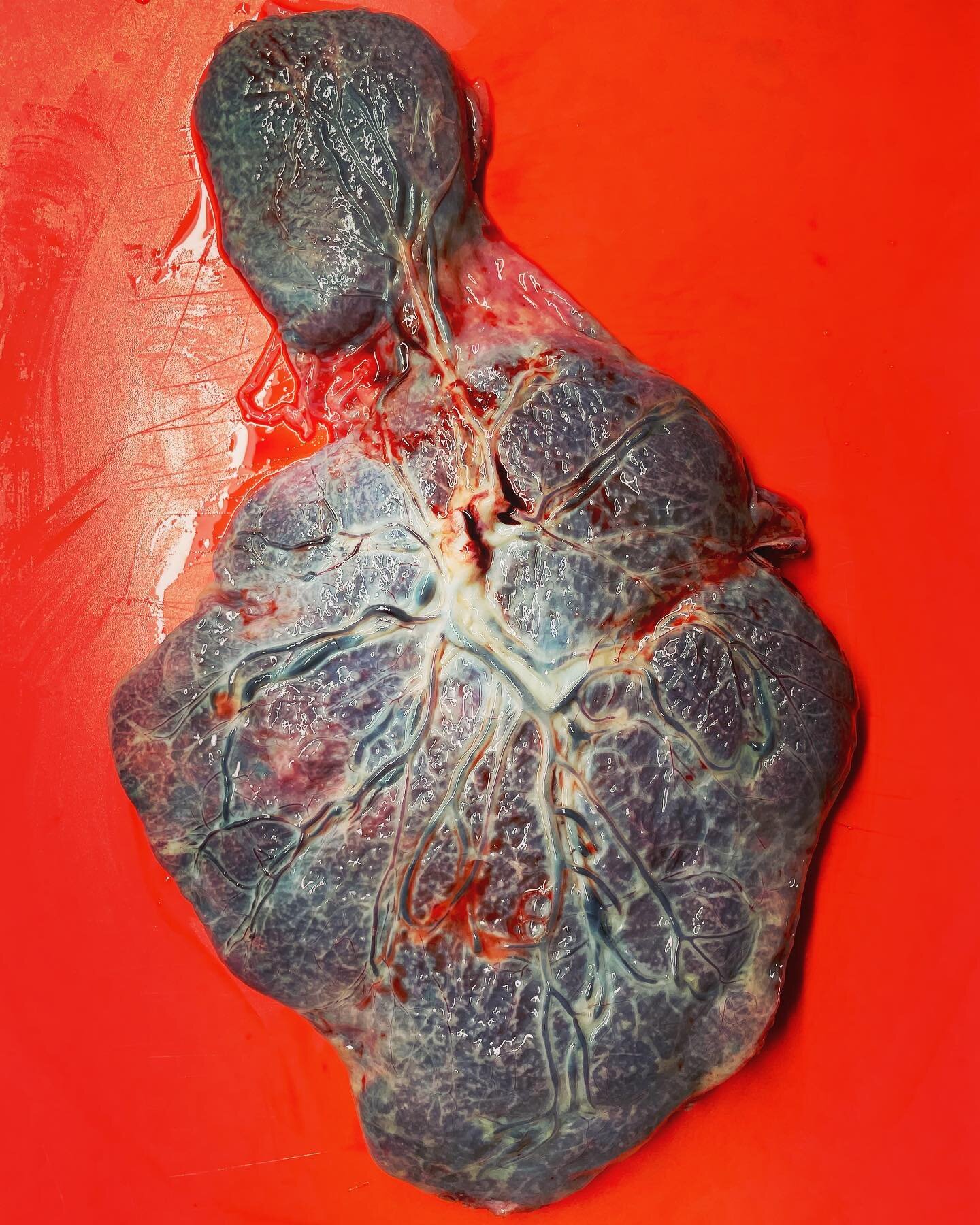 A succenturiate placenta is a variation of placenta morphology. It occurs when one or more accessory lobes develop. It occurs in about 1.7% of pregnancies. You can see that the vessels are only supported by the membranes connecting the two together. 