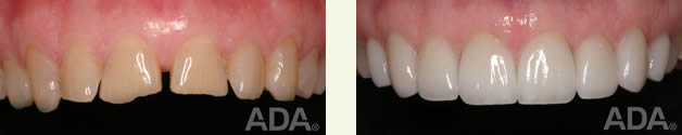 Before veneers After veneers