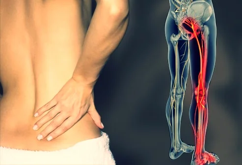 Nerf Sciatique
