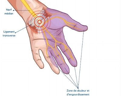 Syndrome du canal carpien : quoi faire pour éviter la chirurgie ...