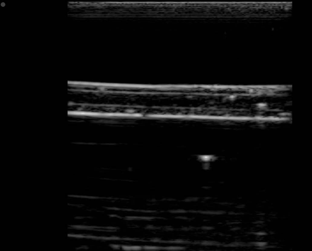 Ultrasound Image of Artery Phantom