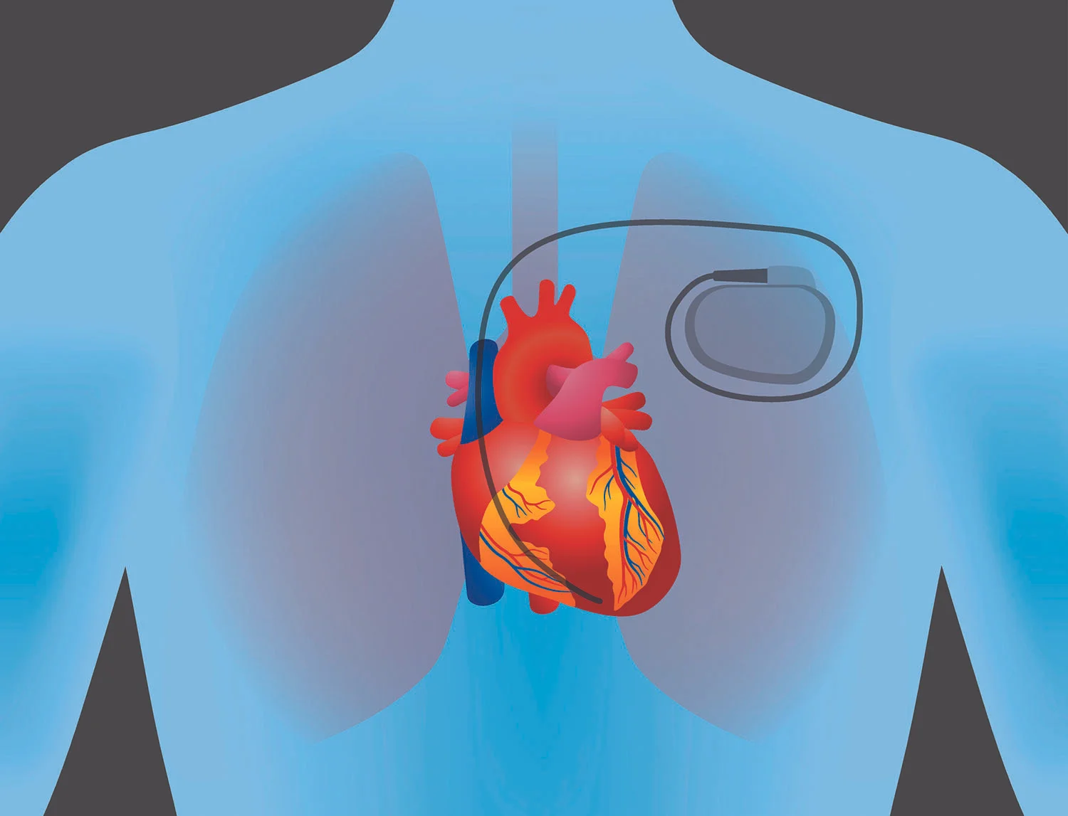 Pacemaker.jpg
