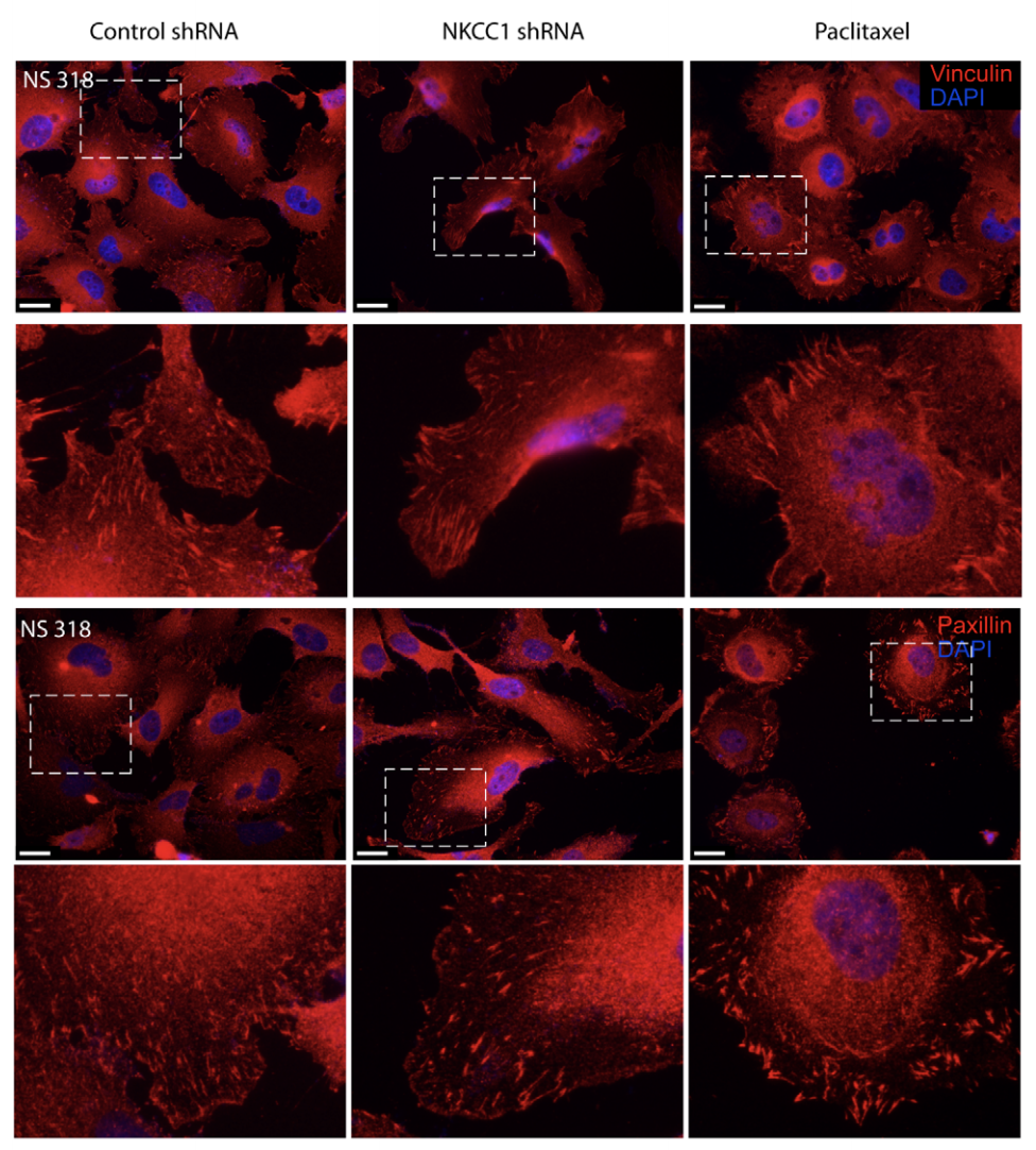 Regulation of Brain Tumor Dispersal by NKCC1 Through a Novel Role in Focal Adhesion Regulation