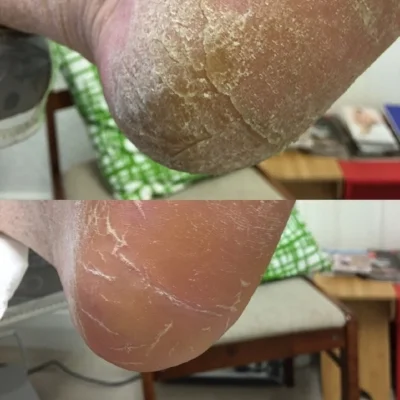 Patient 1.   Medical pedicure- Heel cracks, callous  Top: Before treatment  Bottom: After treatment.  Performed in one appointment by Pulse Podiatry