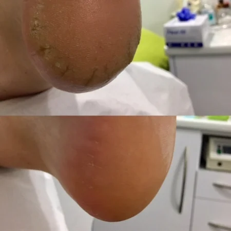 Patient 2.   Medical pedicure- Heel cracks, callous  Top: Before treatment  Bottom: After treatment.  Performed in one appointment by Pulse Podiatry