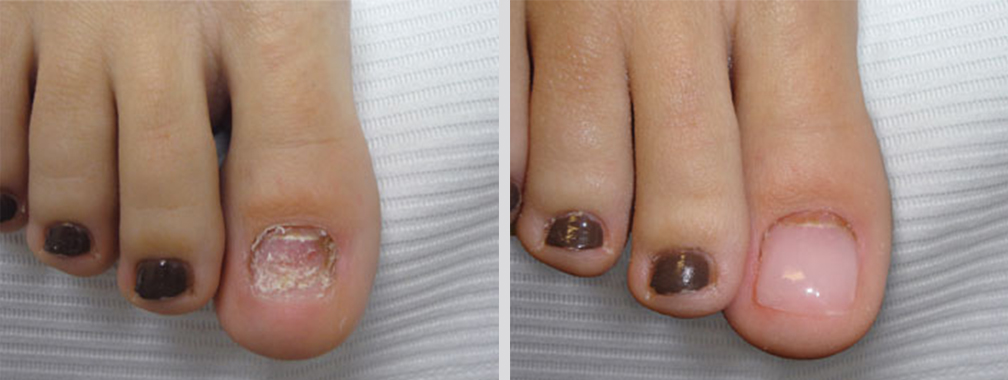 Toe Lengthening and Prosthetic Nail Surgery