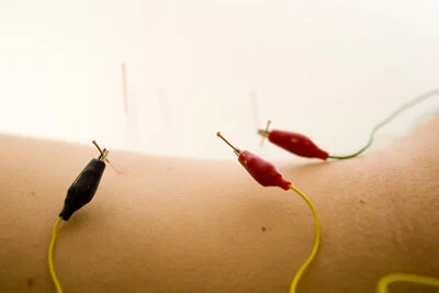 Curious about neuropuncture and acupuncture with electrical stimulation?