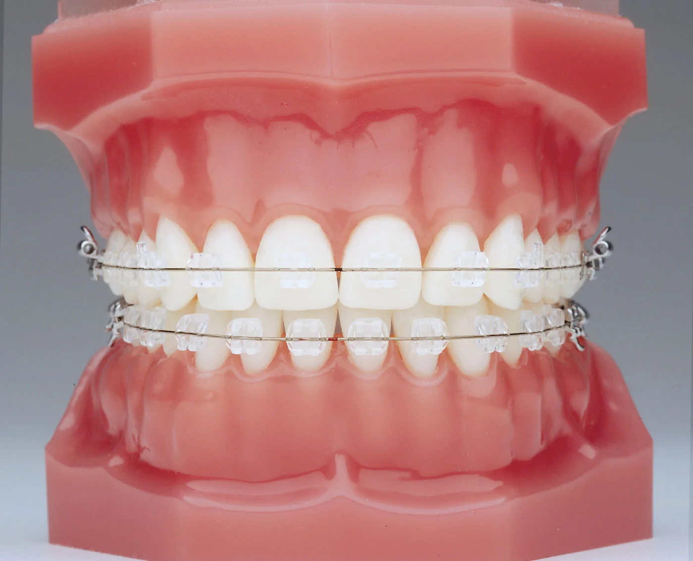 Сапфировые брекеты