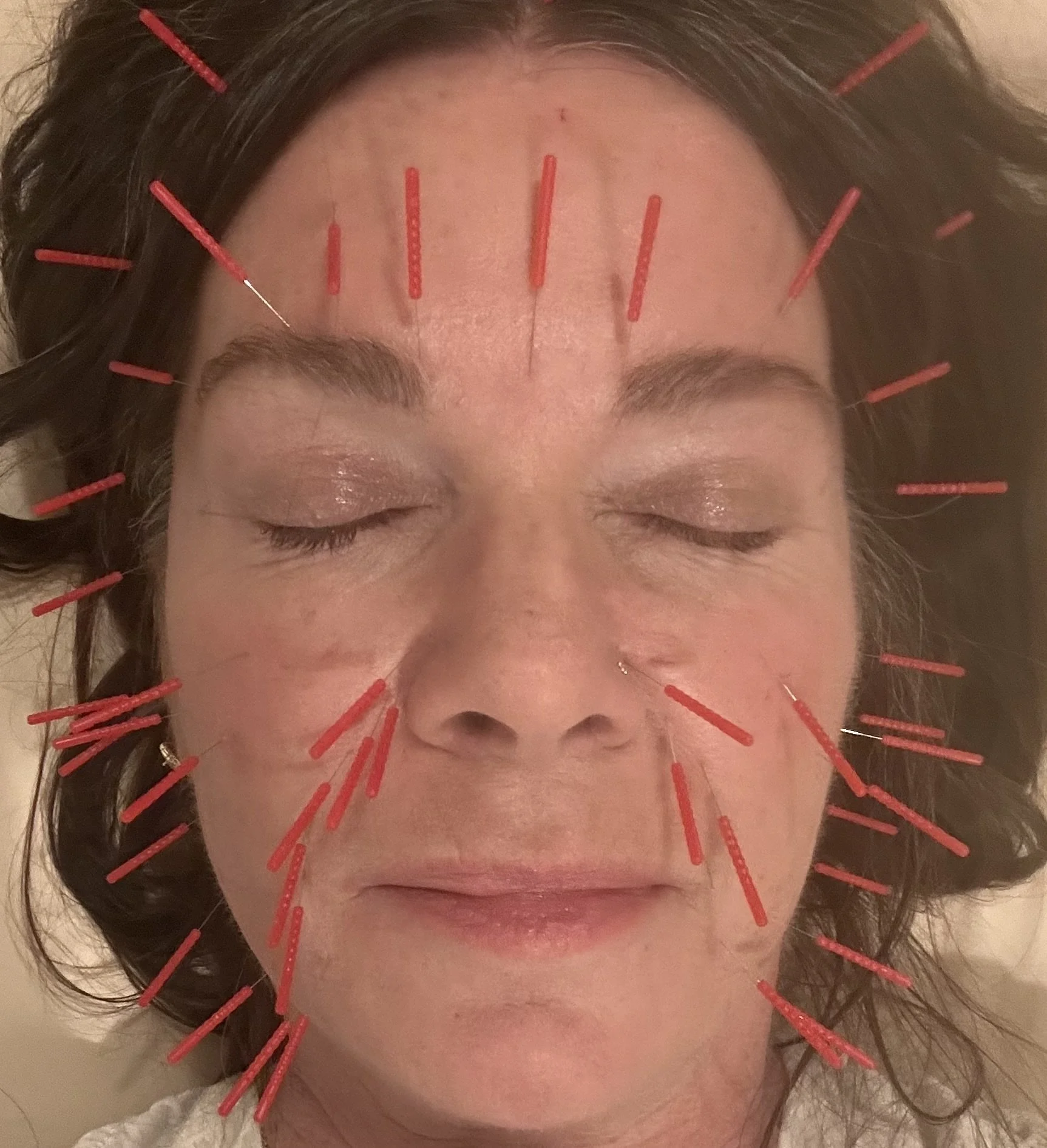 Cosmetic Acupuncture