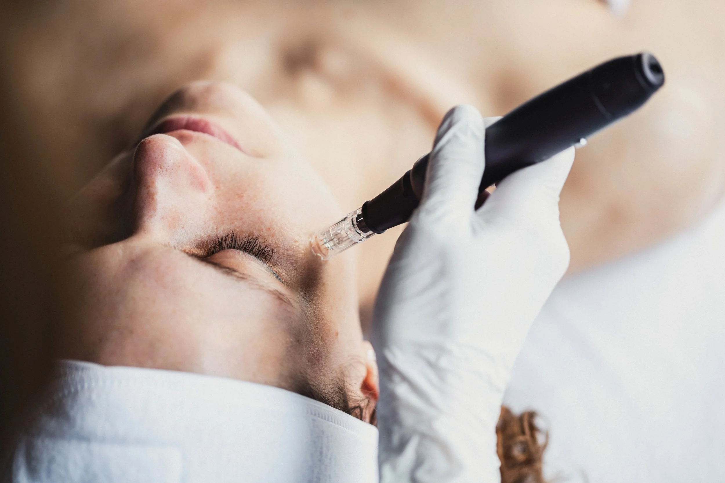 Micro-Needling