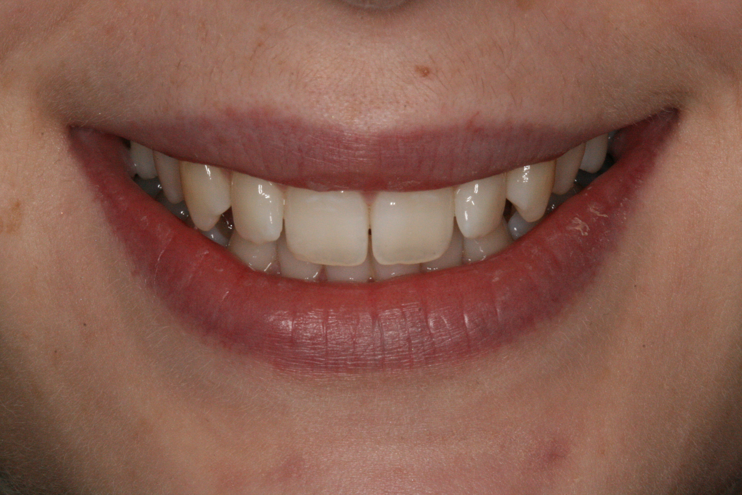 The Tuddenham Road Dental Surgery - Six_Month_Smiles3.JPG