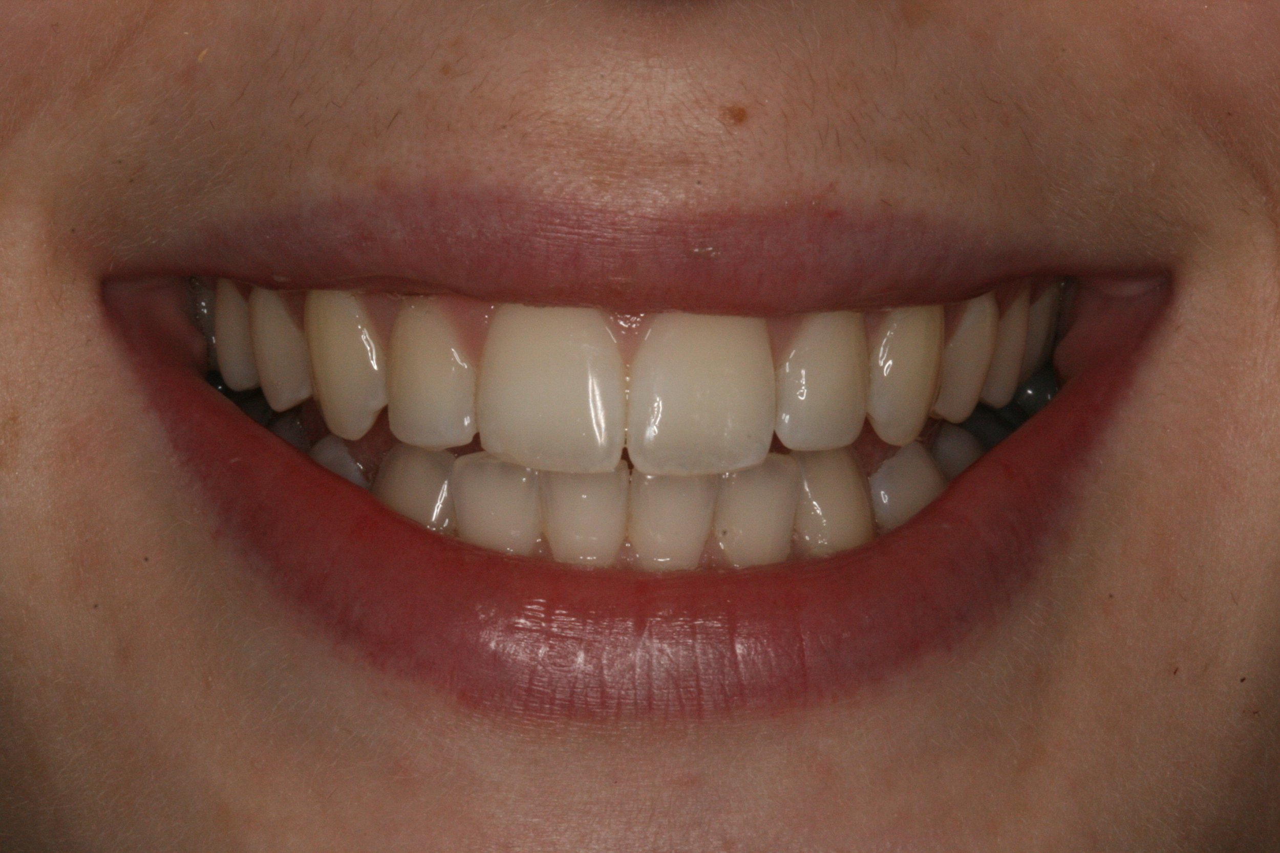 The Tuddenham Road Dental Surgery - Six_Month_Smiles4.JPG